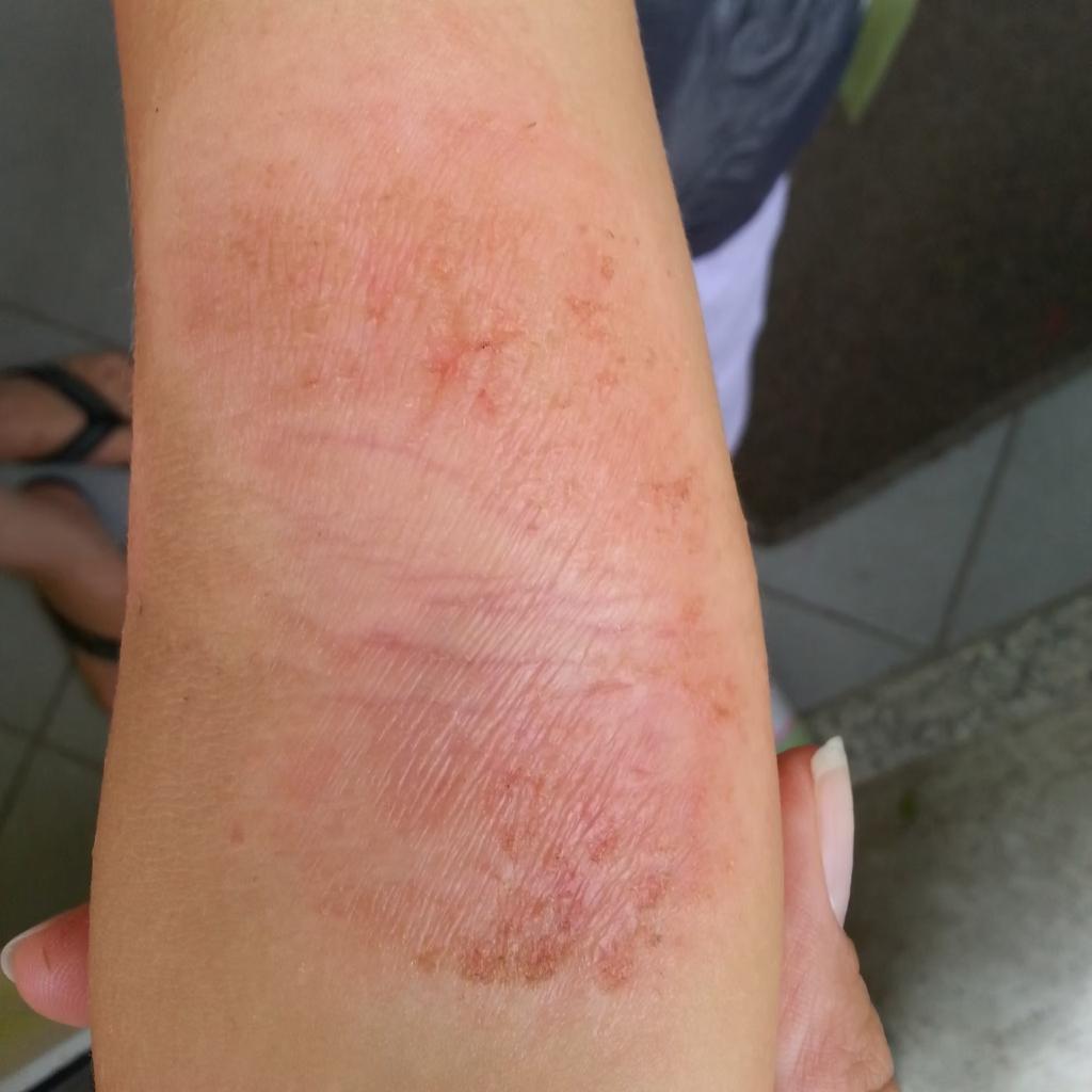 NAŠA IZKUŠNJA Z ATOPIJSKIM DERMATITISOM