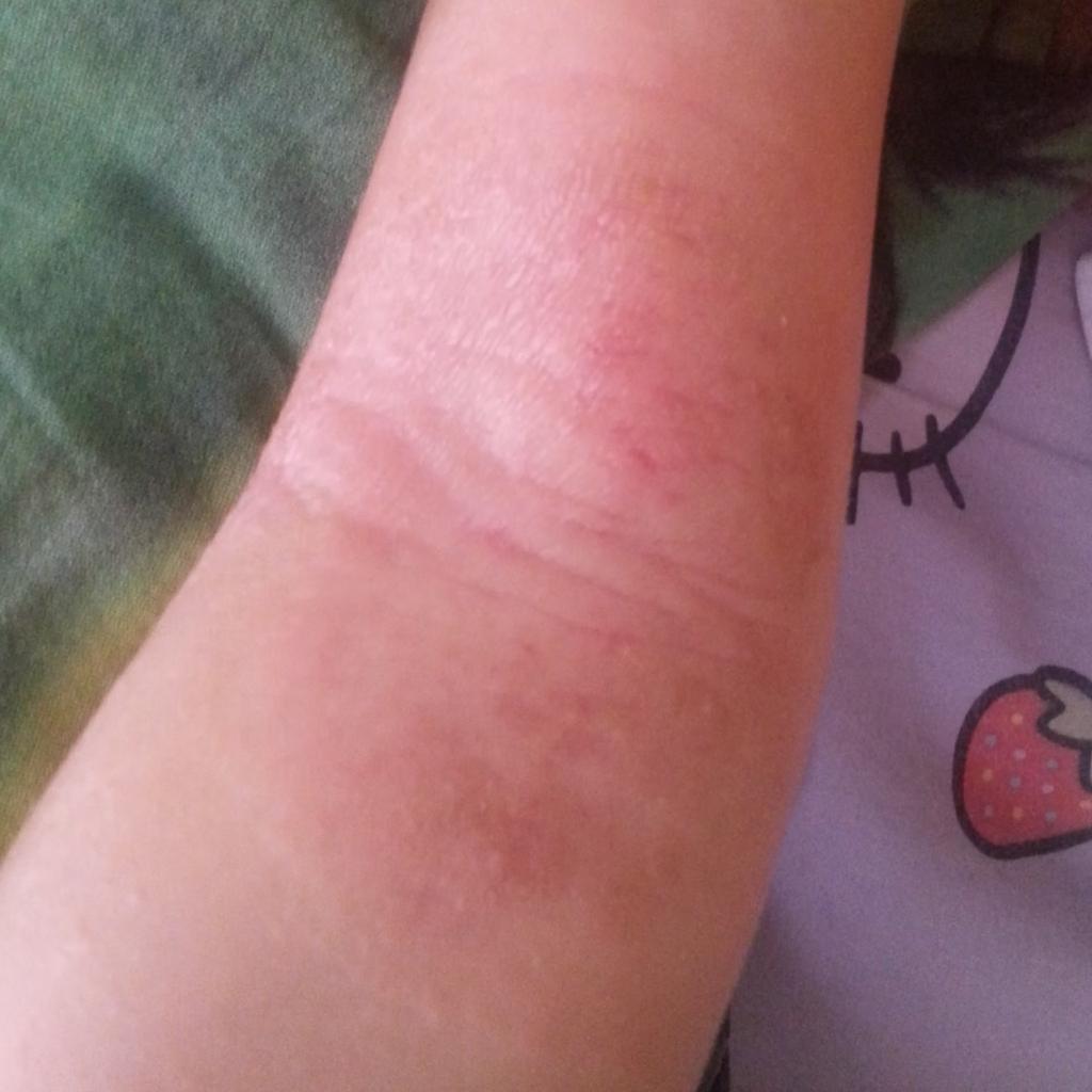 NAŠA IZKUŠNJA Z ATOPIJSKIM DERMATITISOM