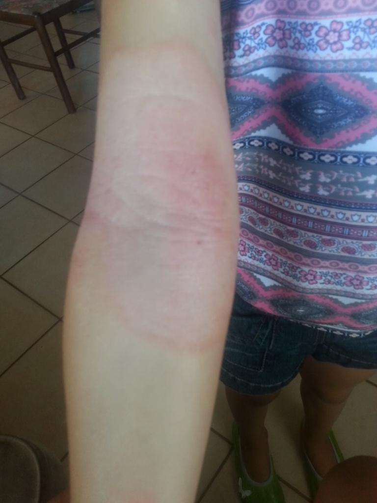NAŠA IZKUŠNJA Z ATOPIJSKIM DERMATITISOM