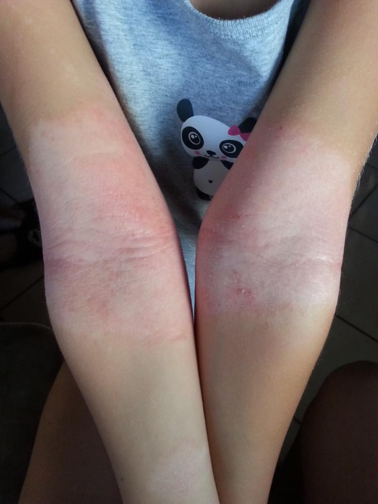 NAŠA IZKUŠNJA Z ATOPIJSKIM DERMATITISOM